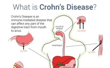 بیماری کرون نوعی بیماری التهابی روده (IBD) است که باعث التهاب و زخم در دستگاه گوارش می شود. این بیماری می تواند هر قسمتی از دستگاه گوارش را از دهان تا مقعد تحت تأثیر قرار دهد، اما بیشتر در روده کوچک و روده بزرگ (کولون) دیده می شود.