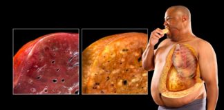 کبد چرب، عارضه‌ای شایع است که در اثر تجمع چربی در کبد ایجاد می‌شود. این بیماری می‌تواند به دلیل عوامل مختلفی مانند چاقی، دیابت نوع 2، کلسترول بالا و مصرف بیش از حد الکل ایجاد شود.